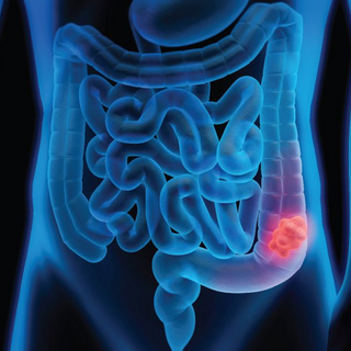 L'alimentation et le cancer colorectal. Quels sont les aliments protecteurs et les aliments à faire attention.