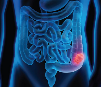 L'alimentation et le cancer colorectal. Quels sont les aliments protecteurs et les aliments à faire attention.