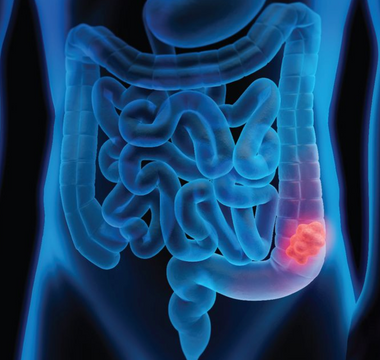 L'alimentation et le cancer colorectal. Quels sont les aliments protecteurs et les aliments à faire attention.